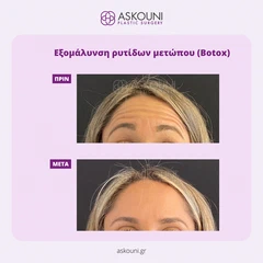 Εξομάλυνση Ρυτίδων Μετώπου | Πριν & Μετά