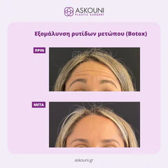 Anti-wrinkle Injections for Forehead Wrinkles | Before & After
