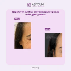 Anti-wrinkle Injections for Crow's Feet | Before & After