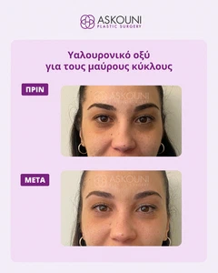 Θεραπεία Μαύρων Κύκλων | Πριν & Μετά