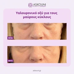 Θεραπεία Μαύρων Κύκλων | Πριν & Μετά