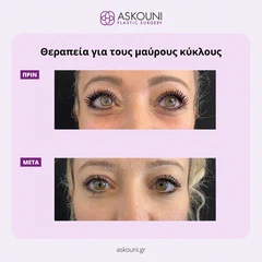 Θεραπεία Μαύρων Κύκλων | Πριν & Μετά