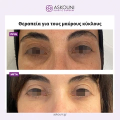 Θεραπεία Μαύρων Κύκλων | Πριν & Μετά