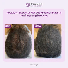 PRP Therapy Against Hair Loss - Male | Before & After