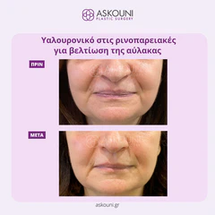 Filler - Face | Before & After