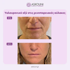 Filler - Face | Before & After