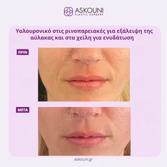 Υαλουρονικό Οξύ - Ρινοπαρειακές | Πριν & Μετά