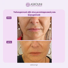 Filler - Face | Before & After