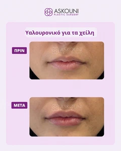 Lips Augmentation using Filler | Before & After