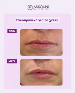 Αυξητική Χειλιών με Filler | Πριν & Μετά