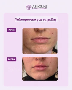 Αυξητική Χειλιών με Filler | Πριν & Μετά