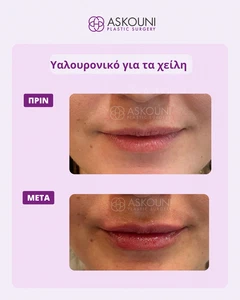 Αυξητική Χειλιών με Filler | Πριν & Μετά