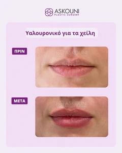 Αυξητική Χειλιών με Filler | Πριν & Μετά