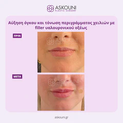 Lips Augmentation using Filler | Before & After