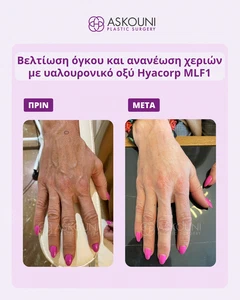 Θεραπεία Αντιγήρανσης Χεριών με Υαλουρονικό | Πριν & Μετά