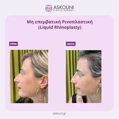 Liquid Rhinoplasty | Before & After