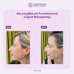Υγρή Ρινοπλαστική | Πριν & Μετά
