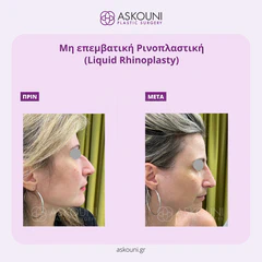 Liquid Rhinoplasty | Before & After
