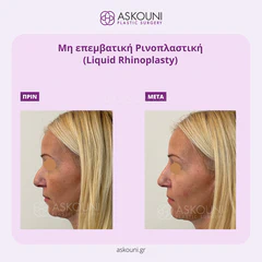 Liquid Rhinoplasty | Before & After