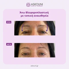 Άνω Βλεφαροπλαστική με Τοπική Αναισθησία - Γυναίκα | Πριν & Μετά