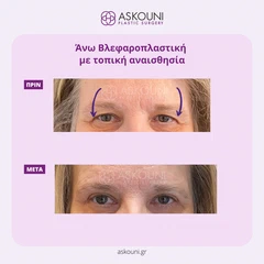 Άνω Βλεφαροπλαστική με Τοπική Αναισθησία - Γυναίκα | Πριν & Μετά