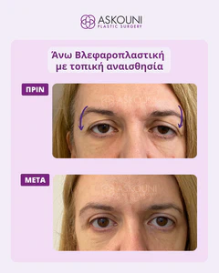 Upper Blepharoplasty under Local Anaesthesia - Female | Before & After