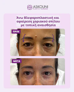Upper Blepharoplasty under Local Anaesthesia - Female | Before & After