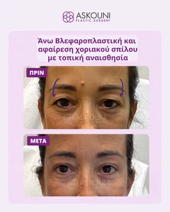 Άνω Βλεφαροπλαστική με Τοπική Αναισθησία - Γυναίκα | Πριν & Μετά