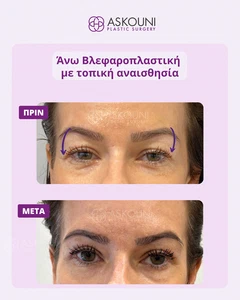 Άνω Βλεφαροπλαστική με Τοπική Αναισθησία - Γυναίκα | Πριν & Μετά
