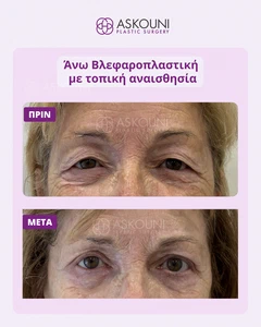 Άνω Βλεφαροπλαστική με Τοπική Αναισθησία - Γυναίκα | Πριν & Μετά
