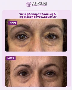 Upper Blepharoplasty & Xanthelasma Removal under Local Anaesthesia - Female | Before & After