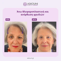Upper Blepharoplasty and Brow Lift - Female | Before & After