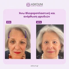 Άνω Βλεφαροπλαστική και Ανόρθωση Φρυδιών - Γυναίκα | Πριν & Μετά
