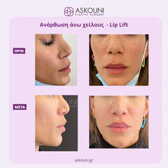 Lip Lift | Before & After