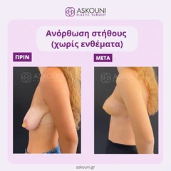 Ανόρθωση Στήθους | Πριν & Μετά