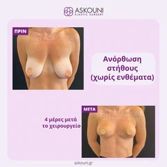 Ανόρθωση Στήθους | Πριν & Μετά