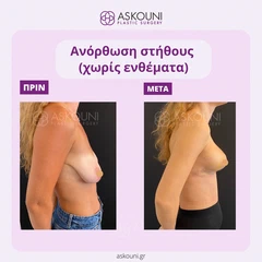Ανόρθωση Στήθους | Πριν & Μετά