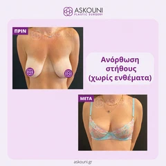 Ανόρθωση Στήθους | Πριν & Μετά