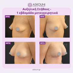 Breast Augmentation | Before & After