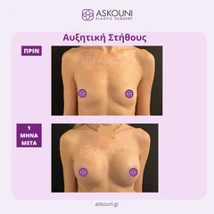 Breast Augmentation | Before & After