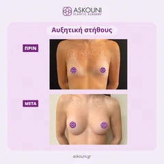 Αυξητική Στήθους | Πριν & Μετά