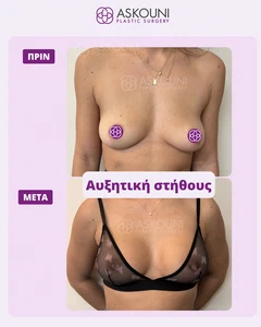 Breast Augmentation | Before & After