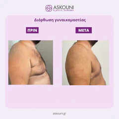 Gynecomastia | Before & After