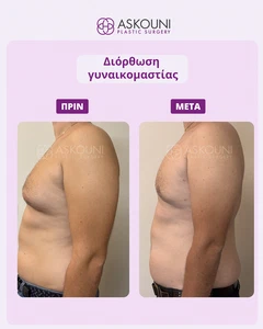 Γυναικομαστία | Πριν & Μετά