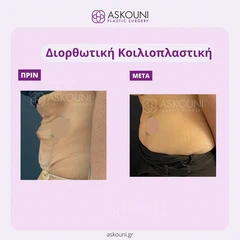 Διορθωτική Κοιλιοπλαστική - Γυναίκα | Πριν & Μετά