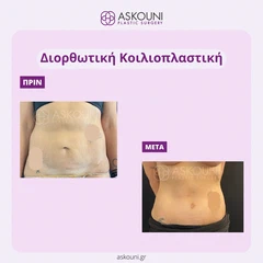 Διορθωτική Κοιλιοπλαστική - Γυναίκα | Πριν & Μετά