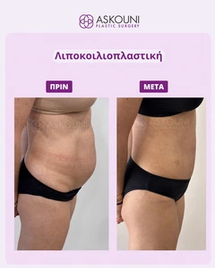 Λιποκοιλιοπλαστική - Γυναίκα - 6 Εβδομάδες | Πριν & Μετά