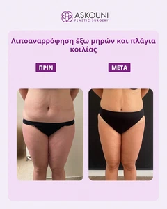 Λιποαναρρόφηση Κοιλιακής Χώρας - Γυναίκα | Πριν & Μετά