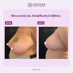 Breast Reduction & Lift | Before & After