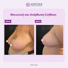 Μειωτική & Ανόρθωση Στήθους | Πριν & Μετά